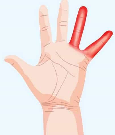 Tê ngón tay út: Nguyên nhân, biểu hiện bệnh lý, cách điều trị