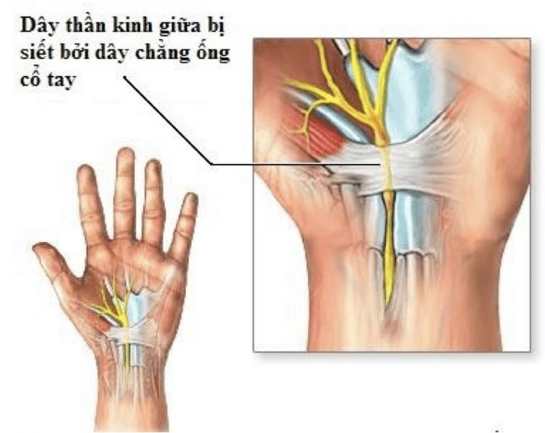hoi chung ong co tay la gi