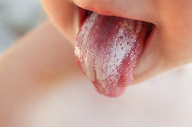 Bệnh Nấm Lưỡi Ở Trẻ Em: Khái Niệm, Nguyên Nhân, Triệu Chứng, Chuẩn Đoán, Điều Trị Và Phòng Bệnh