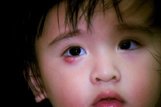 Cách phòng tránh bệnh lẹo mắt ở trẻ em như thế nào?