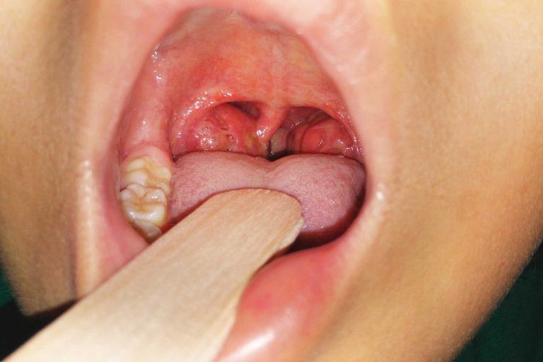 Top 5 Cách Chữa Viêm Amidan Ở Trẻ Tại Nhà Đơn Giản, Không Dùng Thuốc 27 cach chua viem amidan o tre em hieu qua