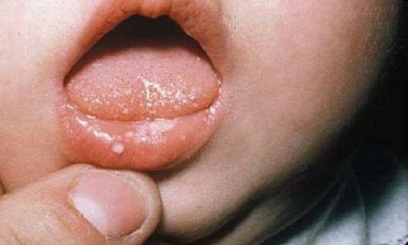 Thông tin nơi chữa Bệnh Nấm Lưỡi Ở Trẻ Em hay ở tphcm