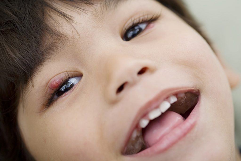 Top 3 Cách Chữa Lẹo Mắt Ở Trẻ Em Đơn Giản Và Hiệu Quả tại nhà không cần đến bác sĩ