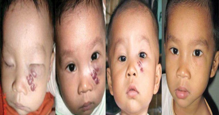 hinh anh benh buu may o tre em co nguy hiem khong
