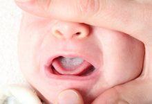 Photo of Thuộc Lòng 6 Thông Tin Cơ Bản Về Bệnh Nấm Lưỡi Ở Trẻ Em