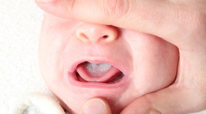 Địa chỉ điều trị Bệnh Nấm Lưỡi Ở Trẻ Em hiệu quả nhất