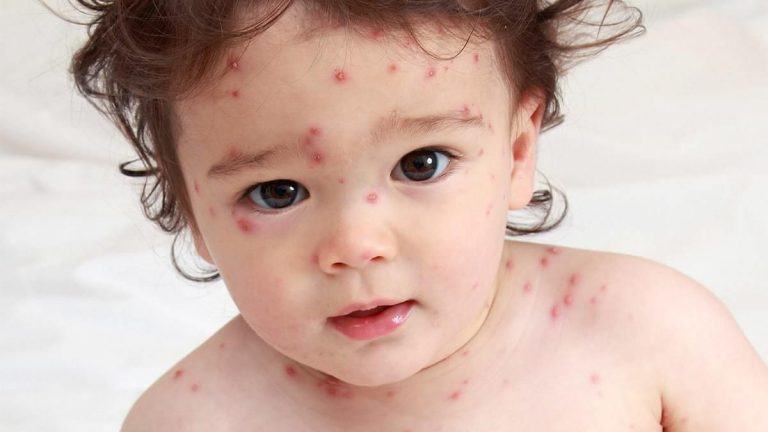 Bệnh thủy đậu ở trẻ em cần kiêng gì và 5 điều kiêng kị 18 benh thuy dau o tre em can kieng gi 01