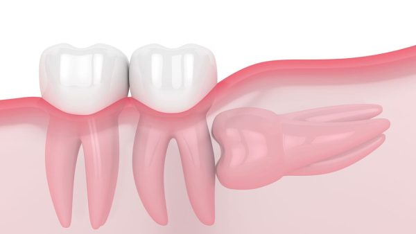 rang so 8 moc ngam phai lam sao 1 600x338 1