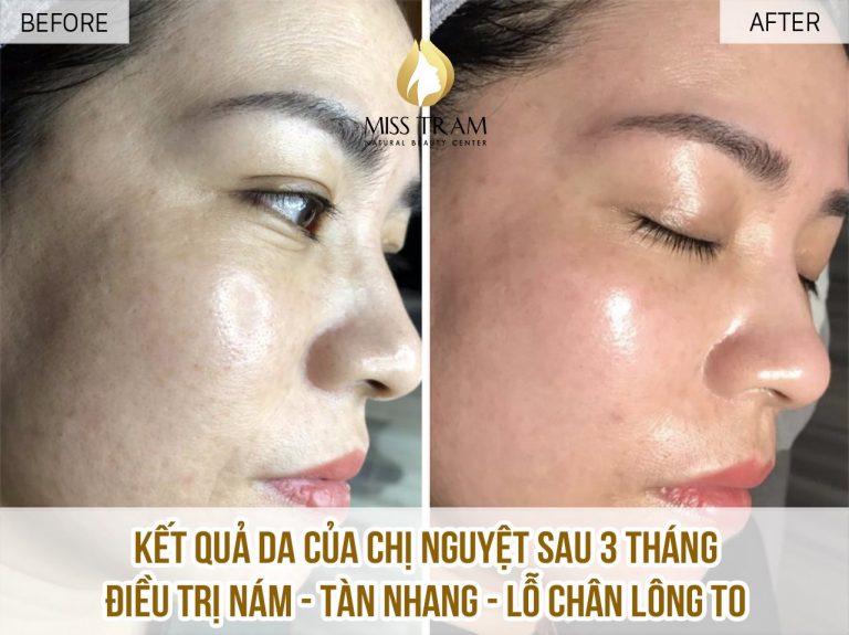 Hỏi Đáp: Nám Da Có Dễ Điều Trị? 12 nam da