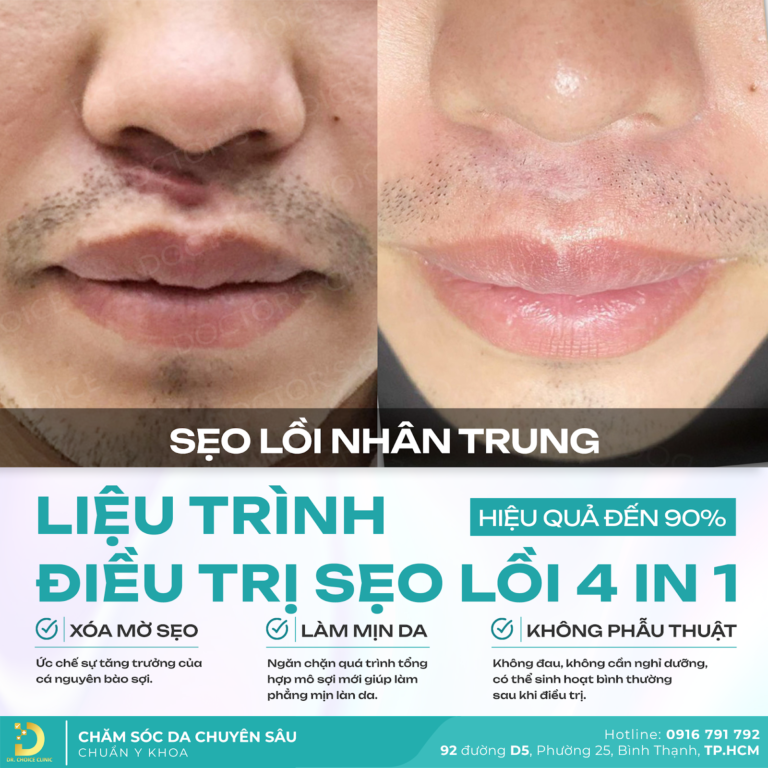 tri seo loi 4